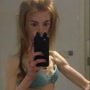 Derbyshire Woman Who Nearly Died From Anorexia Shares Her Road to Recovery