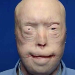 Firefighter Lost His Face in a Rescue — A Mother's Gift Gave It Back