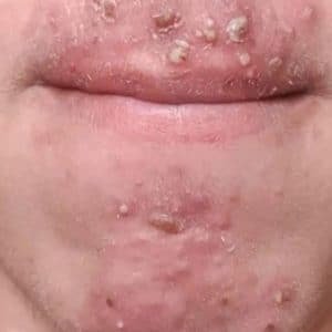 Rash Around Your Mouth? Here's What It Could Be — And When to See a Doctor