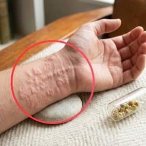 Why Your Skin Breaks Out in Hives — and What It's Actually Trying to Tell You